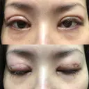 二重埋没 / 目頭切開 / 上まぶたの脂肪取り 十仁美容整形 DAY 0 サムネイル用