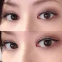 二重埋没 / 目頭切開 / 上まぶたの脂肪取り 十仁美容整形 DAY 190 サムネイル用