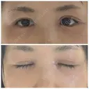 二重切開 / 目頭切開 / 眼瞼下垂（切開） / 目尻切開 湘南美容クリニック 大阪堺東院 DAY 8 サムネイル用