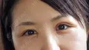 二重切開 / 目頭切開 / 眼瞼下垂（切開） / 目尻切開 湘南美容クリニック 大阪堺東院 DAY 8 サムネイル用