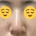 鼻尖縮小 / ヒアルロン酸注入（鼻） 東京ヒルズクリニック 新宿院 DAY 10 サムネイル用