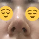 鼻尖縮小 / ヒアルロン酸注入（鼻） 東京ヒルズクリニック 新宿院 DAY 10 サムネイル用