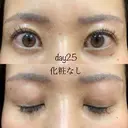 眉下切開 湘南美容クリニック 秋葉原院 DAY 25 サムネイル用