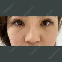 ヒアルロン酸注入（鼻） 銀座TAクリニック DAY 0 サムネイル用