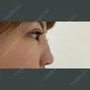 ヒアルロン酸注入（鼻） 銀座TAクリニック DAY 0 サムネイル用