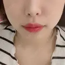 脂肪溶解注射（顔） 赤坂プレミアクリニック DAY 3 サムネイル用