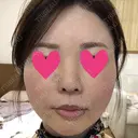脂肪注入（輪郭） テラクリニック DAY 65 サムネイル用