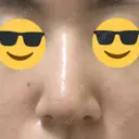 鼻尖縮小 / ヒアルロン酸注入（鼻） 東京ヒルズクリニック 新宿院 DAY 11 サムネイル用