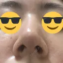 鼻尖縮小 / ヒアルロン酸注入（鼻） 東京ヒルズクリニック 新宿院 DAY 11 サムネイル用