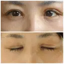 二重切開 / 目頭切開 / 眼瞼下垂（切開） / 目尻切開 湘南美容クリニック 大阪堺東院 DAY 10 サムネイル用