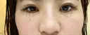ヒアルロン酸注入（鼻） 銀座TAクリニック DAY 1 サムネイル用