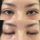 二重埋没 / 目頭切開 / 上まぶたの脂肪取り 十仁美容整形 DAY 0 サムネイル用