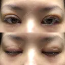 二重埋没 / 目頭切開 / 上まぶたの脂肪取り 十仁美容整形 DAY 0 サムネイル用