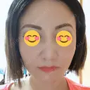 隆鼻術 / 鼻尖形成（切開） / 小鼻縮小（切開） / 軟骨移植 湘南美容クリニック 那覇院 DAY 12 サムネイル用