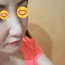 隆鼻術 / 鼻尖形成（切開） / 小鼻縮小（切開） / 軟骨移植 湘南美容クリニック 那覇院 DAY 12 サムネイル用