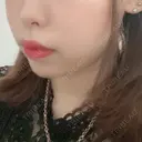 脂肪溶解注射（顔） 赤坂プレミアクリニック DAY 5 サムネイル用