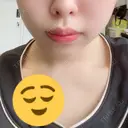 脂肪溶解注射（顔） 赤坂プレミアクリニック AFTER サムネイル用