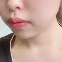 脂肪溶解注射（顔） 赤坂プレミアクリニック DAY 6 サムネイル用