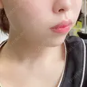 脂肪溶解注射（顔） 赤坂プレミアクリニック DAY 6 サムネイル用