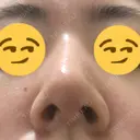 鼻尖縮小 / ヒアルロン酸注入（鼻） 東京ヒルズクリニック 新宿院 DAY 14 サムネイル用