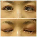 二重切開 / 目頭切開 / 眼瞼下垂（切開） / 目尻切開 湘南美容クリニック 大阪堺東院 DAY 13 サムネイル用