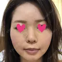 脂肪注入（輪郭） テラクリニック DAY 69 サムネイル用