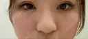 ヒアルロン酸注入（鼻） 銀座TAクリニック AFTER サムネイル用