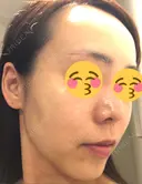 糸リフト / ボトックス（あご） / 肌ヒアルロン酸注入（たるみ・シワ改善） / ボトックス（口角） 湘南美容クリニック 秋葉原院 DAY 22 サムネイル用