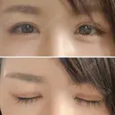 二重切開 / 目頭切開 / 眼瞼下垂（切開） / 目尻切開 湘南美容クリニック 大阪堺東院 DAY 14 サムネイル用