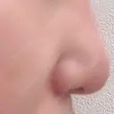 鼻尖形成（切開） / 小鼻縮小（切開） / 鼻孔縁挙上 銀座TAクリニック DAY 49 サムネイル用