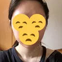 ボトックス（エラ・小顔） 東京ヒルズクリニック 新宿院 DAY 3 サムネイル用