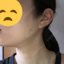 ボトックス（エラ・小顔） 東京ヒルズクリニック 新宿院 DAY 3 サムネイル用