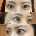眉下切開 湘南美容クリニック 秋葉原院 DAY 31 サムネイル用