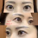 眉下切開 湘南美容クリニック 秋葉原院 DAY 31 サムネイル用