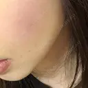 脂肪注入（輪郭） テラクリニック DAY 71 サムネイル用