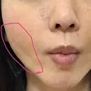 脂肪注入（輪郭） テラクリニック DAY 71 サムネイル用