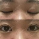 二重埋没 東京形成美容外科 船橋院 DAY 60 サムネイル用