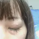 二重埋没 品川スキンクリニック沖縄院 DAY 52 サムネイル用