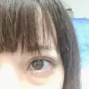 二重埋没 品川スキンクリニック沖縄院 DAY 52 サムネイル用