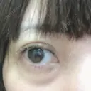 二重埋没 品川スキンクリニック沖縄院 DAY 52 サムネイル用