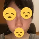 鼻尖縮小 東京ヒルズクリニック 新宿院 DAY 4 サムネイル用