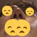 鼻尖縮小 東京ヒルズクリニック 新宿院 DAY 4 サムネイル用