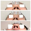 ヒアルロン酸注入（鼻） BIANCA銀座 DAY 32 サムネイル用