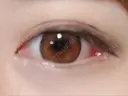 目頭切開 / 目尻切開 FROM B整形外科 (旧バウム整形外科) DAY 10 サムネイル用