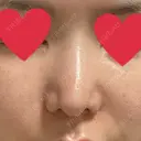 鼻尖形成（切開） / 軟骨移植 / 骨切幅寄せ / 鼻修正 / その他（鼻） 表参道スキンクリニック 表参道院 AFTER サムネイル用