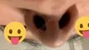 鼻尖形成（切開） / 鼻中隔延長（切開） / その他（鼻） / 軟骨移植 / ボトックス（あご） / ヒアルロン酸注入（あご） / ボトックス（エラ・小顔） / ボトックス（肩） エートップ美容整形外科 DAY 308 サムネイル用
