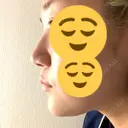 鼻尖形成（切開） / 鼻中隔延長（切開） / その他（鼻） / 軟骨移植 / ボトックス（あご） / ヒアルロン酸注入（あご） / ボトックス（エラ・小顔） / ボトックス（肩） エートップ美容整形外科 DAY 308 サムネイル用