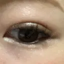 二重埋没 / 脂肪吸引（顔） 表参道スキンクリニック 表参道院 DAY 12 サムネイル用