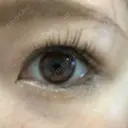 二重埋没 / 脂肪吸引（顔） 表参道スキンクリニック 表参道院 DAY 14 サムネイル用