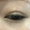 二重埋没 / 脂肪吸引（顔） 表参道スキンクリニック 表参道院 DAY 14 サムネイル用